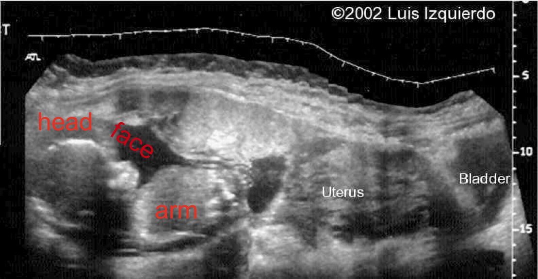 abdominal pregnancy abdominal pregnancy