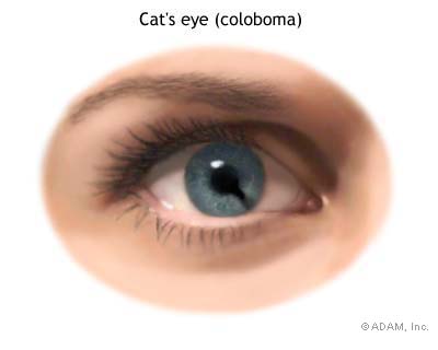 Coloboma with a more defined "keyhole" shape Coloboma with a more defined "keyhole" shape