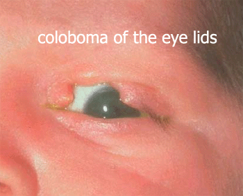 Coloboma affecting the eyelid Coloboma affecting the eyelid