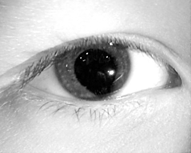 Coloboma Coloboma