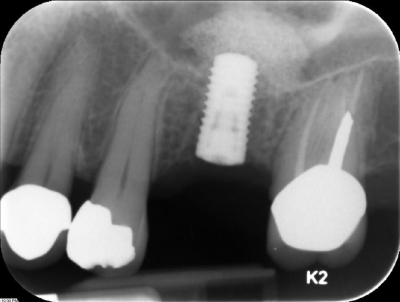 This is a representative photo from Wikipedia, not my personal implant.) xray of a dental implant