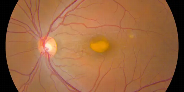 Gene Mutations In Retinal Lesions From Vitelliform Macular Dystrophy Found