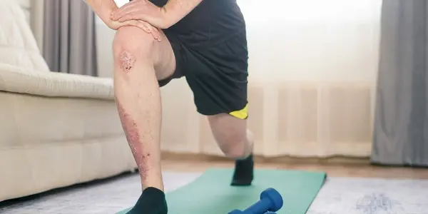 Losing Weight Improves The Heartbreak Of Psoriasis For Some