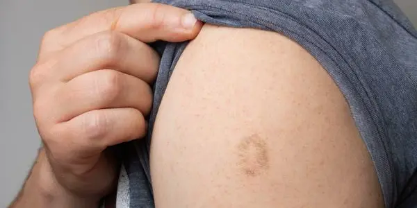 At 3 Cases In 6 Months, Monkeypox In The US Is Effectively Contained